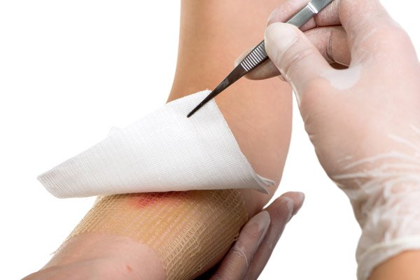 Tissue Viability – Assessment and Treatment of Wound